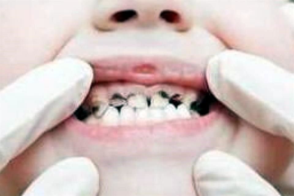 La Secretaría de Salud informó que 7 de cada 10 niños y adolescentes tiene caries, y 2 de cada 10 tienen enfermedad periodontal.