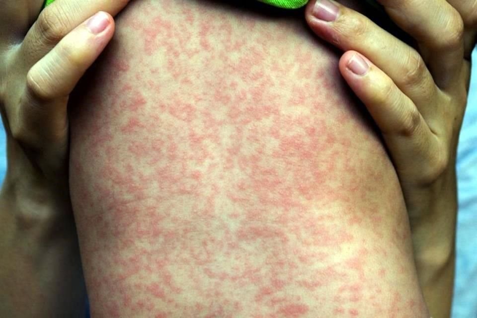 Los cuatro casos de sarampión detectados en el País fueron por importación del virus, por lo que el surgimiento de un brote queda descartado, explicó Kuri Morales.