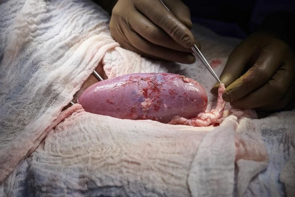 Científicos realizaron el trasplante en septiembre de 2021 en un hospital de NYU Langone Health.