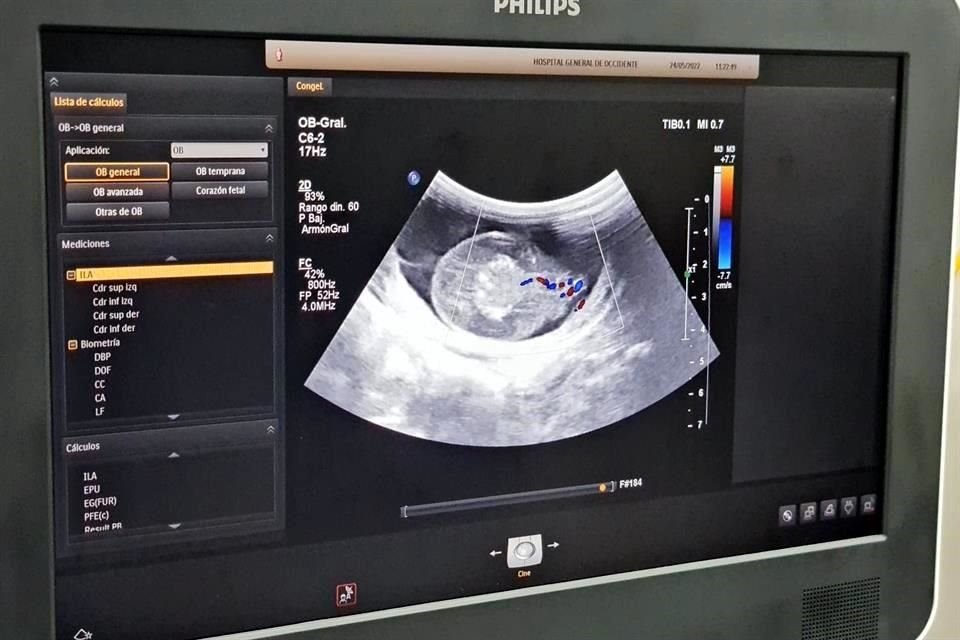 La intervención en el vientre materno se realizó a fetos con 17 semanas de gestación.