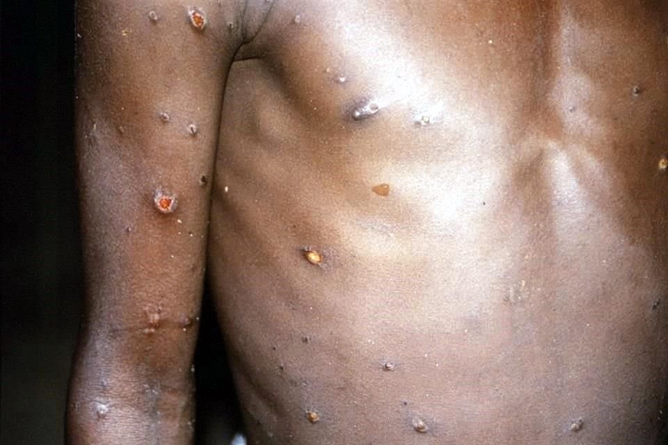 Jalisco suma 22 casos de viruela del mono, todos hombres entre 25 y 40 años, cuyo principal lugar de residencia es GDL y Puerto Vallarta.