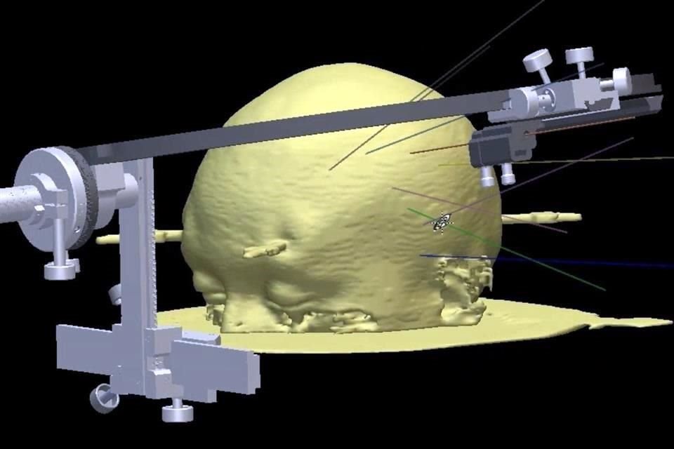 La estereoelectroencefalografía (SEEG, por sus siglas en inglés), consiste en la implantación de microelectrodos en lo profundo del cerebro para identificar la zona epileptógena.