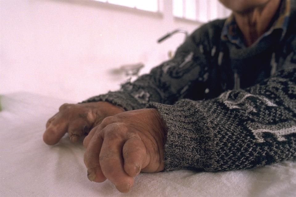 Aunque Jalisco reportó 11 casos de lepra en 2023, la detección de la enfermedad va a la baja; buscan erradicarla en seis años
