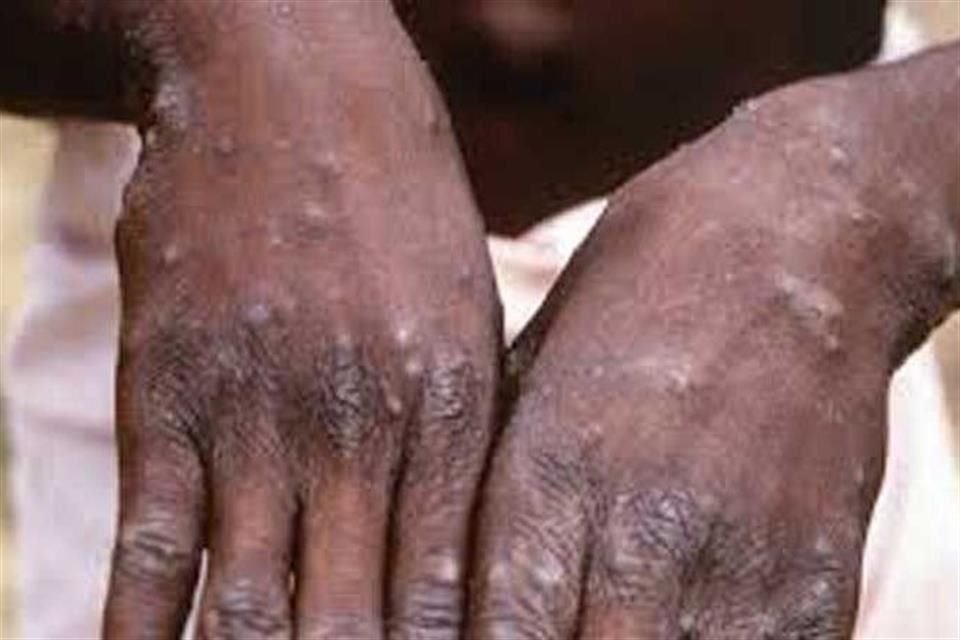 En el 2025, durante la semana epidemiológica 23 se han registrado 43 casos confirmados de Mpox en territorio jalisciense.