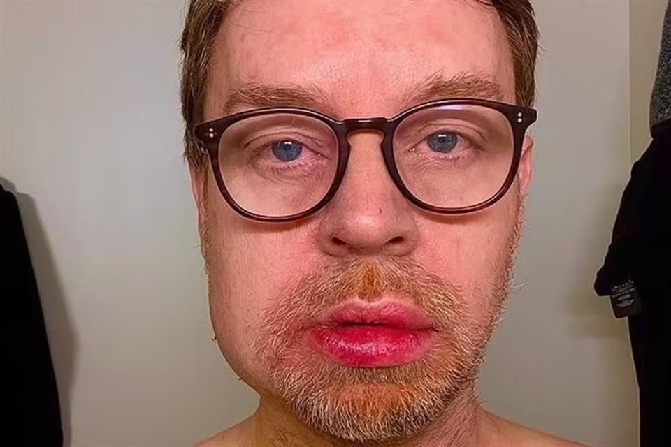 Darren Hayes mostró como quedó su mandíbula.