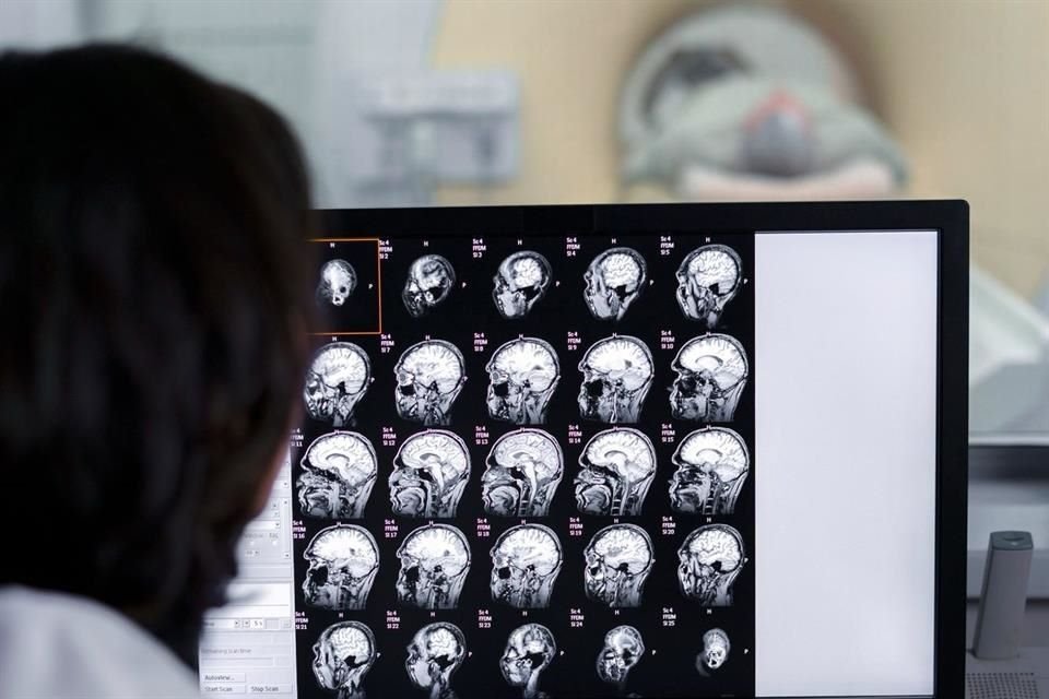 El éxito del tratamiento de tumores cerebrales depende de un diagnóstico temprano y atención especializada.