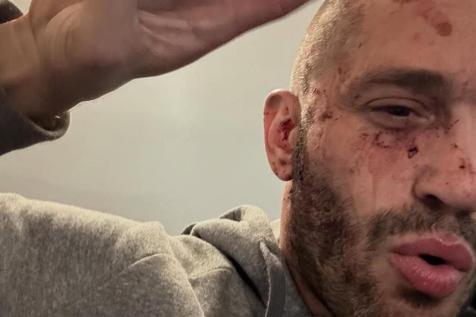 En otro posteo, Philippou compartió una foto de él ensangrentado y con cicatrices. 'Estoy limpio y bien. Los amo, México'.