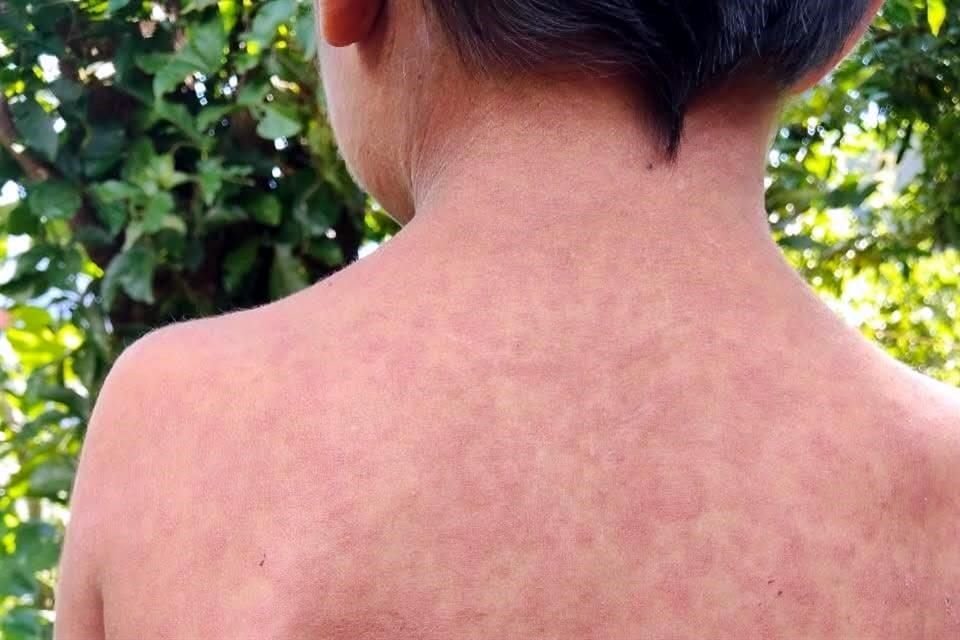 Autoridades sanitarias investigan la primera posible muerte por sarampión en Jalisco y dos casos que requirieron hospitalización.