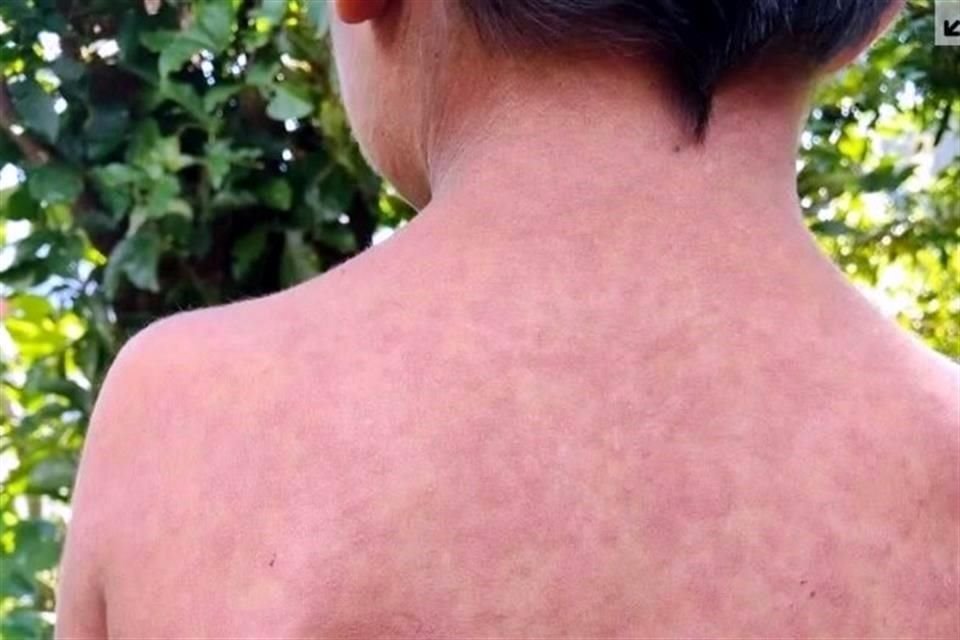 En Jalisco están por notificarse 10 casos más de sarampión, informó el Secretario de Salud, Héctor Raúl Pérez Gómez.